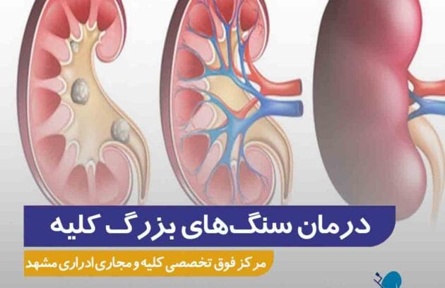 درمان سنگ کلیه