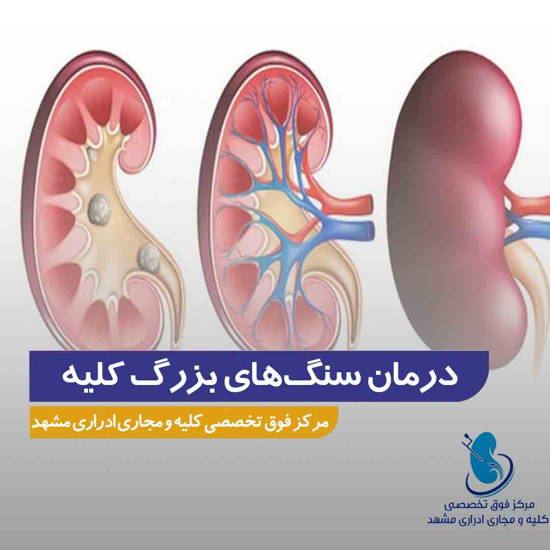 درمان سنگ‌ های بزرگ کلیه