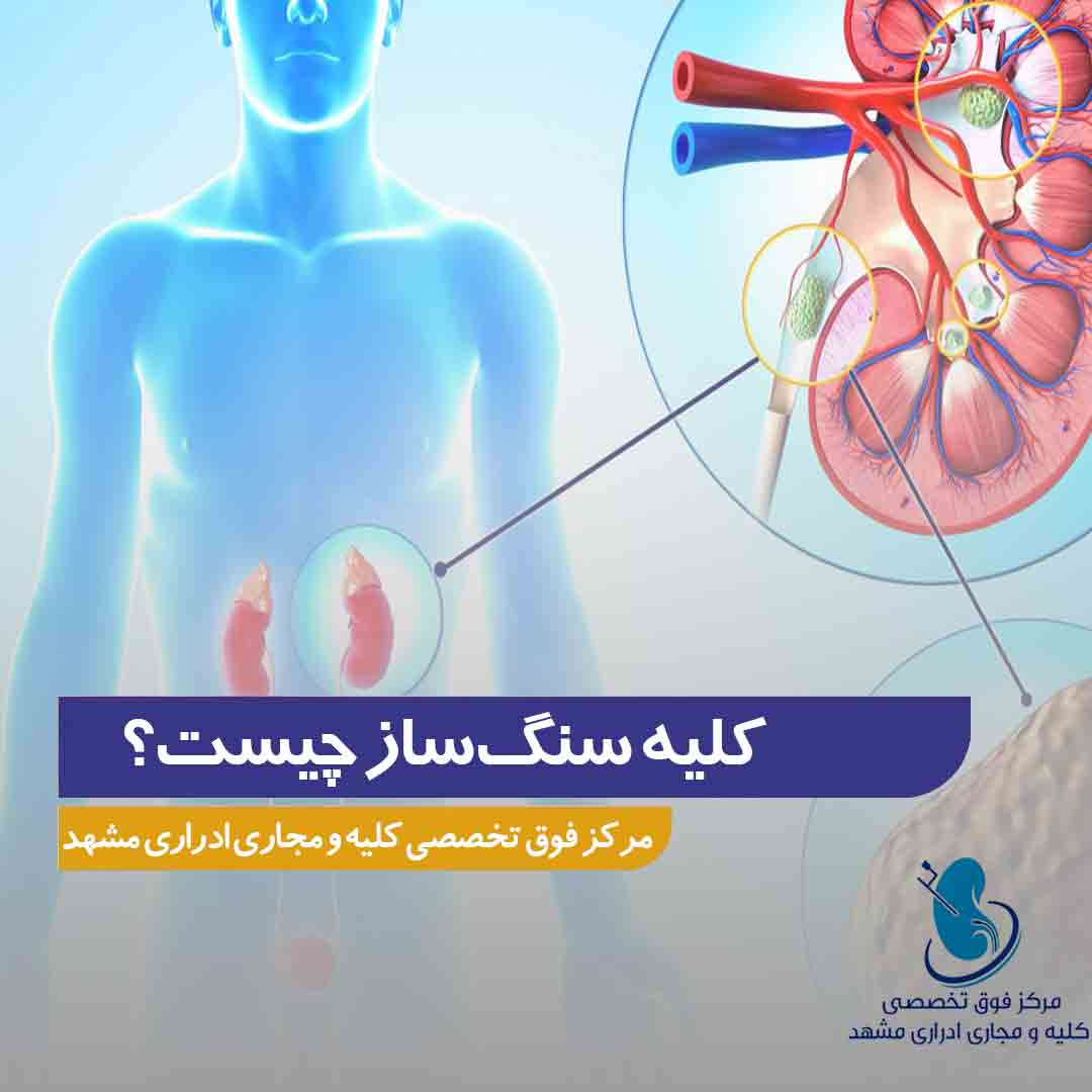 کلیه سنگ‌ ساز چیست؟
