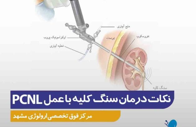 نکات قبل و بعد از درمان سنگ کلیه با استفاده از عمل PCNL