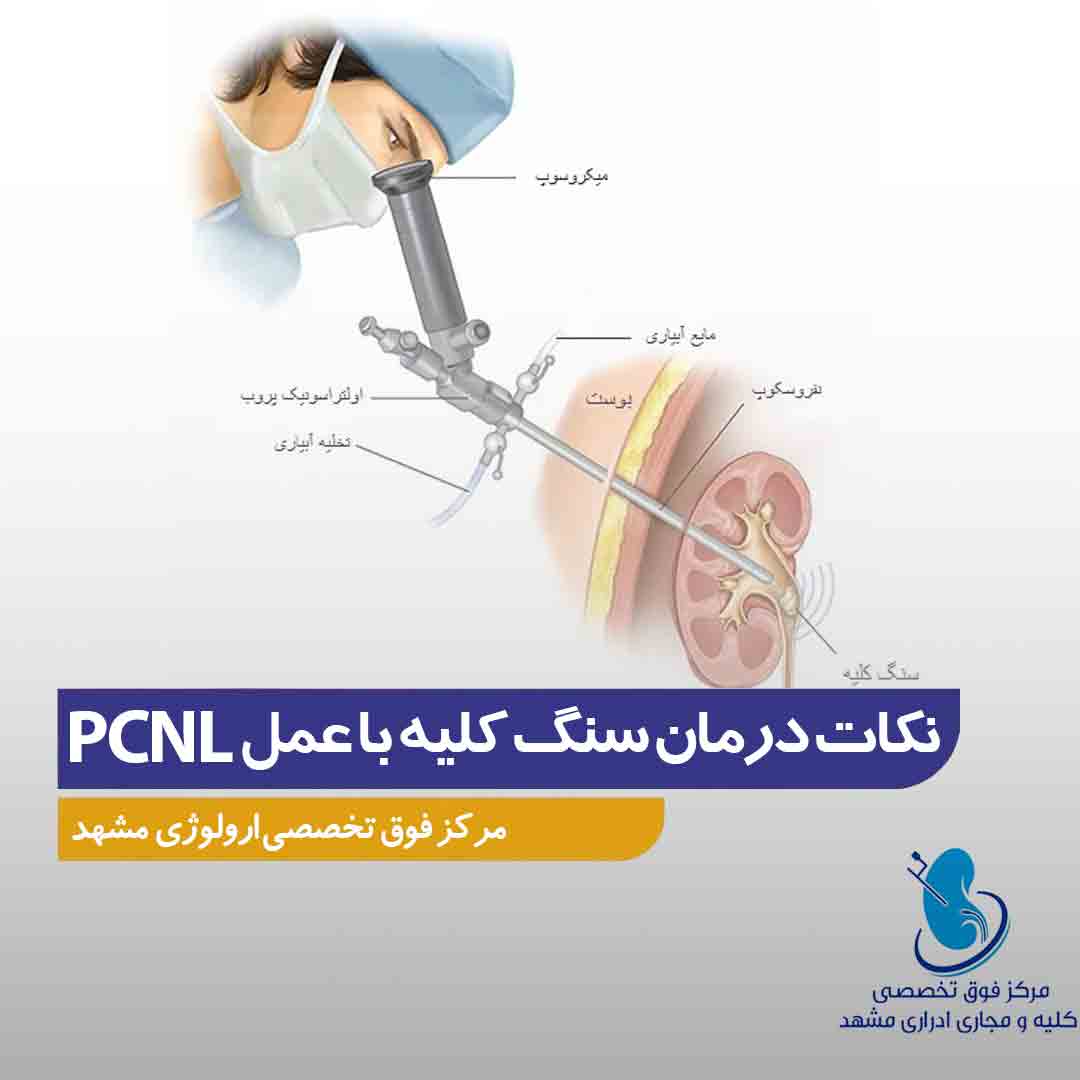 نکات قبل و بعد از درمان سنگ کلیه با عمل PCNL
