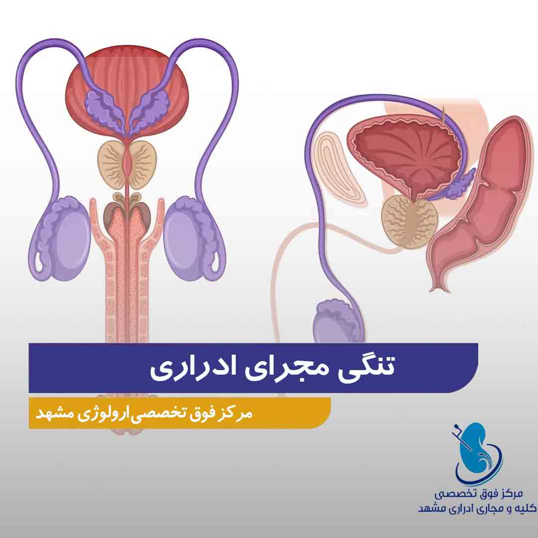 تنگی مجرای ادراری
