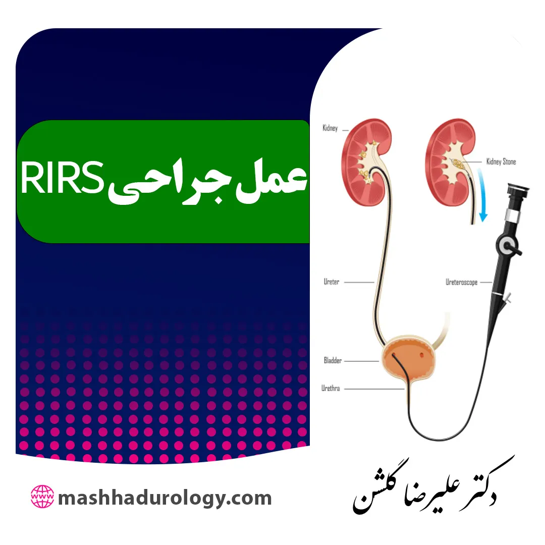 عمل RIRS چیست و چه سنگ هایی را از بین می برد؟
